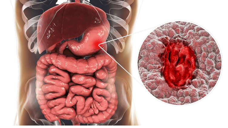 What Is Gut Health & Why Does It Matter? The Complete Indian Guide